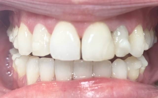 Smile Reveal By Our Patients - Carstairs Dental