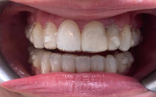 Halfway there with Orthodontics & Teeth Whitening Treatment - Carstairs Dental
