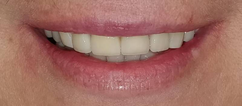 Smile Reveal #4 A classic example of smile improvement with Veneers - Carstairs Dental
