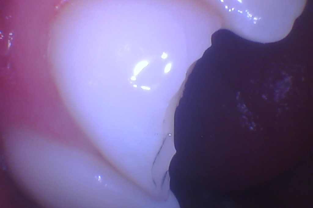 fixed tooth in Carstairs Dental Alberta