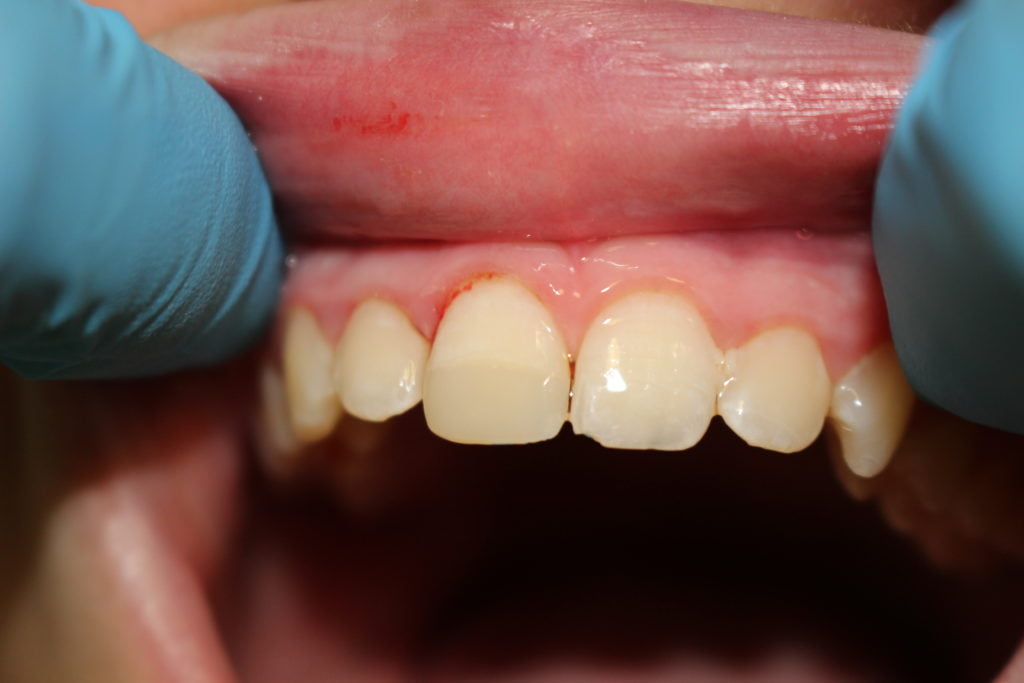 fixed tooth in Carstairs Dental Alberta