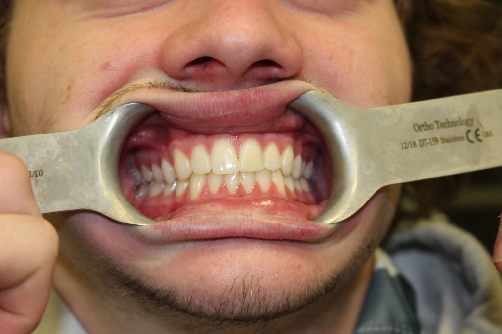 fixed tooth in Carstairs Dental Alberta