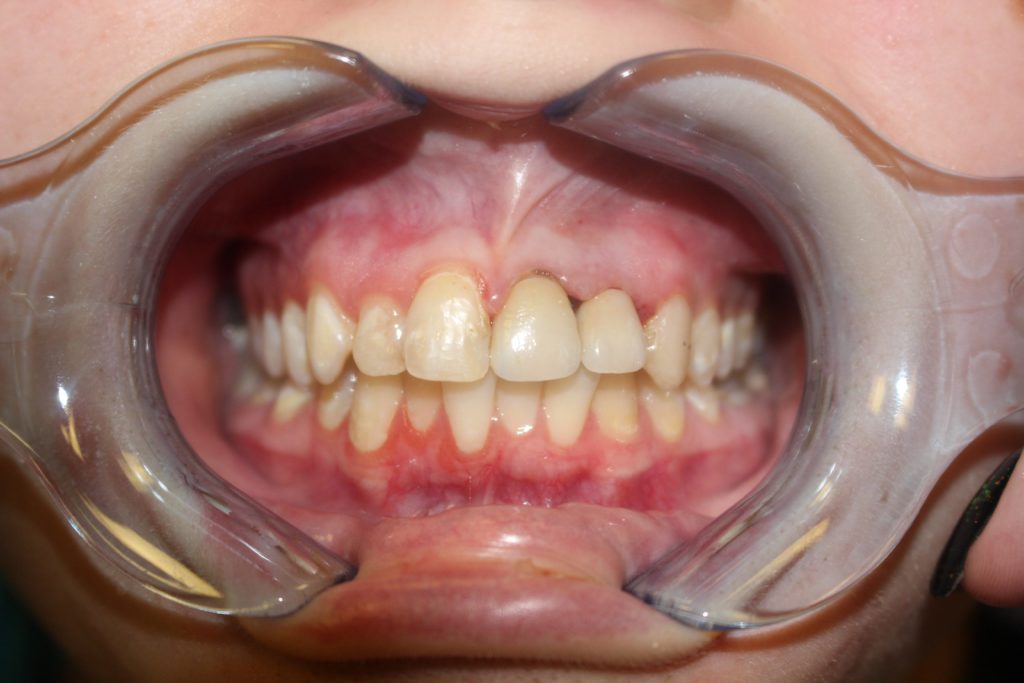 dental crown carstairs Dental Alberta