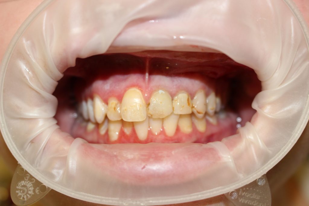dental crown carstairs Dental Alberta