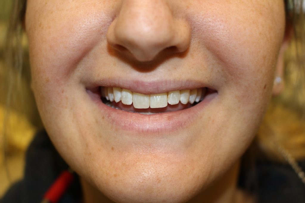 dental crown carstairs Dental Alberta