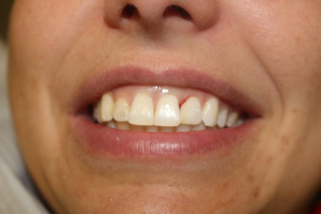 dental crown carstairs Dental Alberta