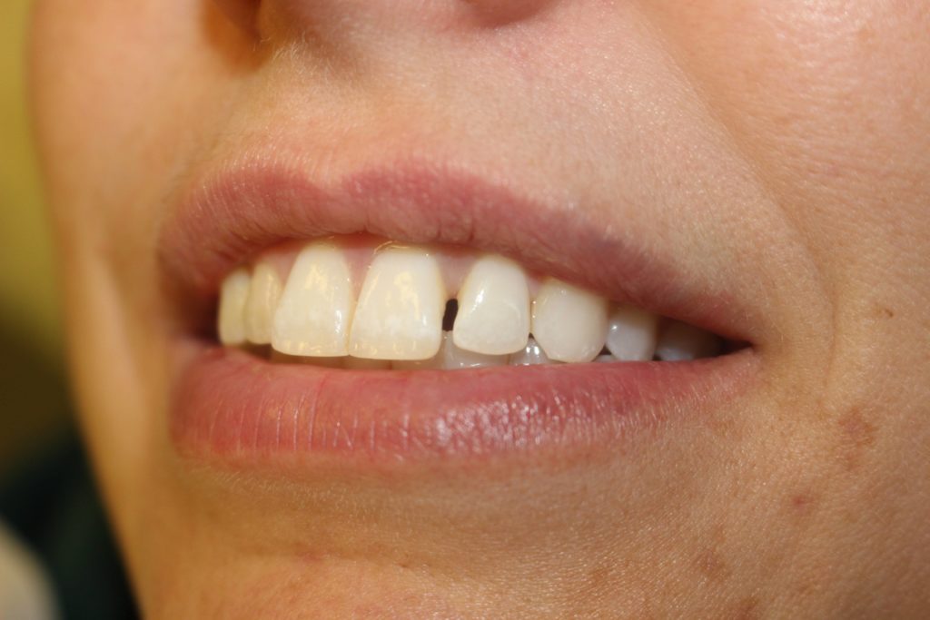 dental crown carstairs Dental Alberta
