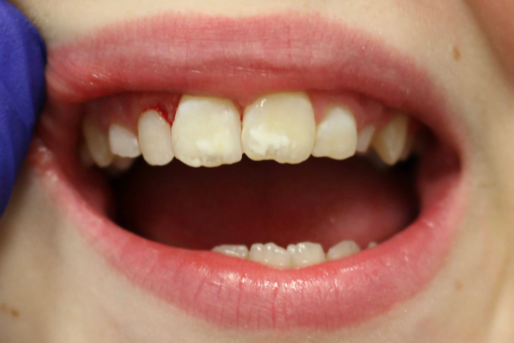dental crown carstairs Dental Alberta