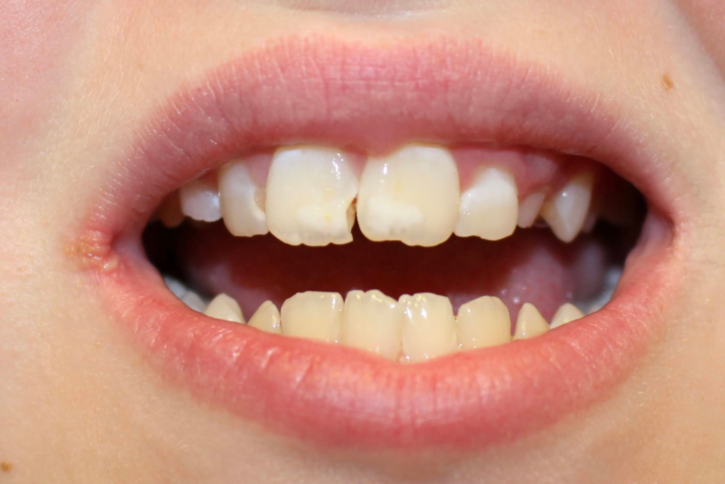 dental crown carstairs Dental Alberta