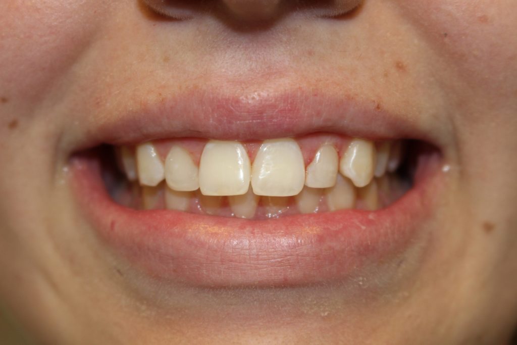 dental crown carstairs Dental Alberta