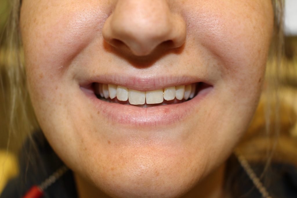 dental crown carstairs Dental Alberta
