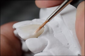 Dental Bonding Dentist Carstairs Dental Alberta