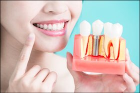 Dental Implants Dentist Carstairs Dental Alberta