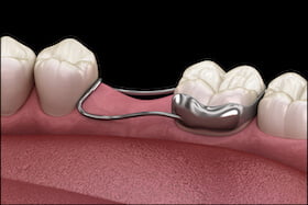 Excessive Space In Between Two Teeth Dentist | Carstairs Dental Clinic | Dentist in Carstairs, AB