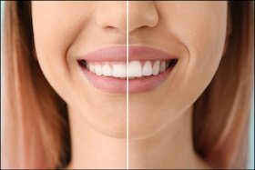 Gum Contouring Dentist Carstairs Dental Alberta