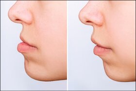 Jaw Correction Dentist Carstairs Dental Alberta