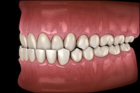 Mild To Moderate Bite Issues