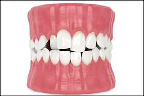 Misaligned Jaw Dentist | Carstairs Dental Clinic | Dentist in Carstairs, AB