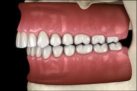 Overbite Issues Dentist Carstairs Dental Alberta