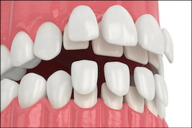 Porcelain Veneers Dentist Carstairs Dental Alberta