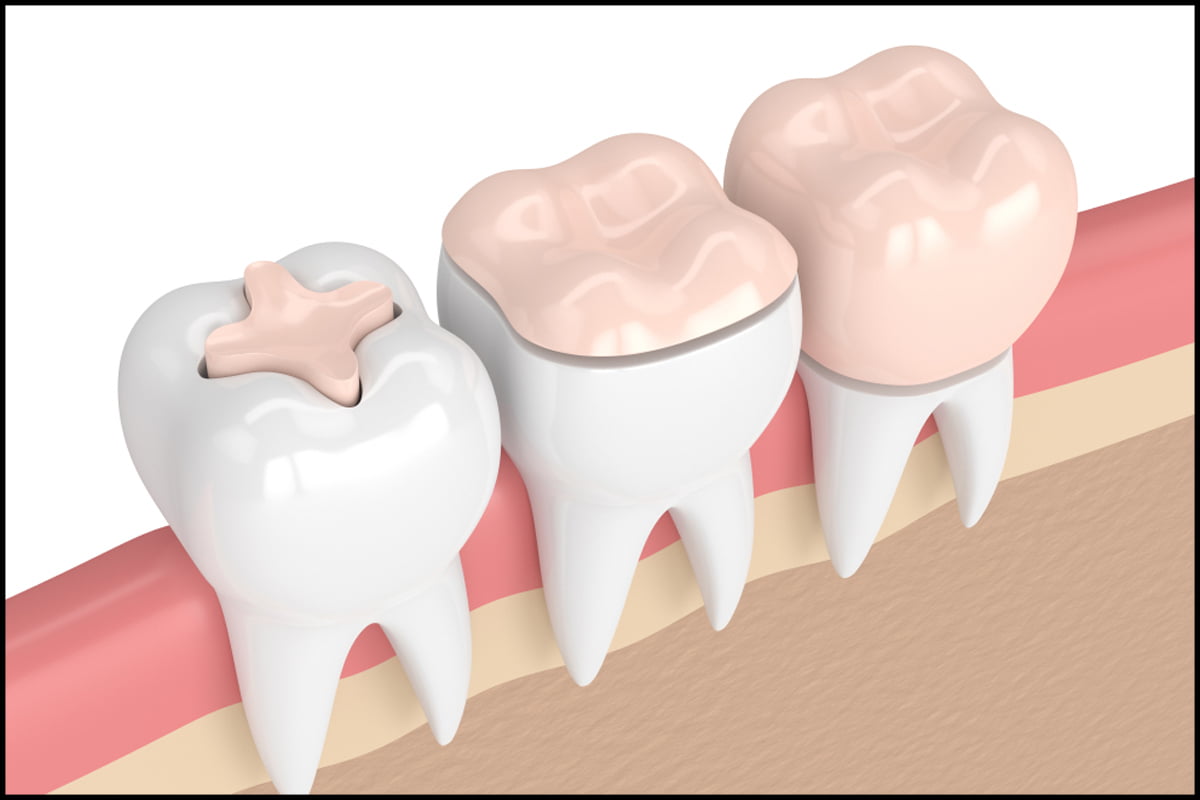 Porcelain Inlays-Onlays dentist in carstairs ab