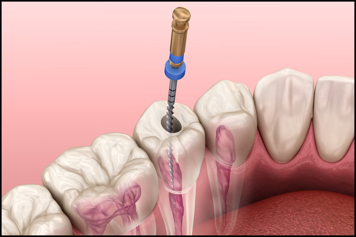 Root Canal Therapy dentist in Carstairs