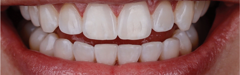 Invisalign