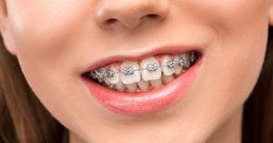 Orthodontic Braces | Carstairs Dental | Dentist in Carstairs, AB