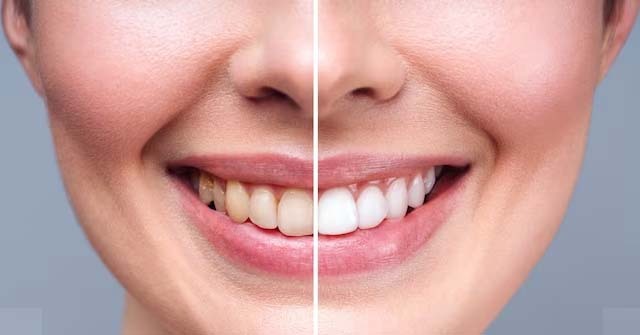 Teeth-Whitening