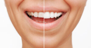 bonded fillings-Carstairs Dental
