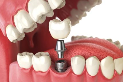 Tooth Restorations Pediatric Dentistry Tooth Restorations